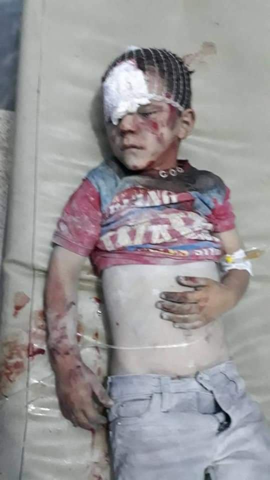 A child injured in alleged Russian airstrikes on Zardana in Idlib, Syria on June 7th, 2018 (via SCD)