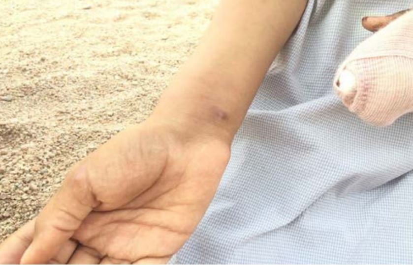 The back of Othman Mohammed Saleh Al Athal’s hand, which shows the scar from one of his injuries from the raid. Photo taken by a Mwatana researcher.