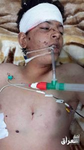 A child injured in alleged Coalition strike on Fallujah March 31st (via News of Iraq)
