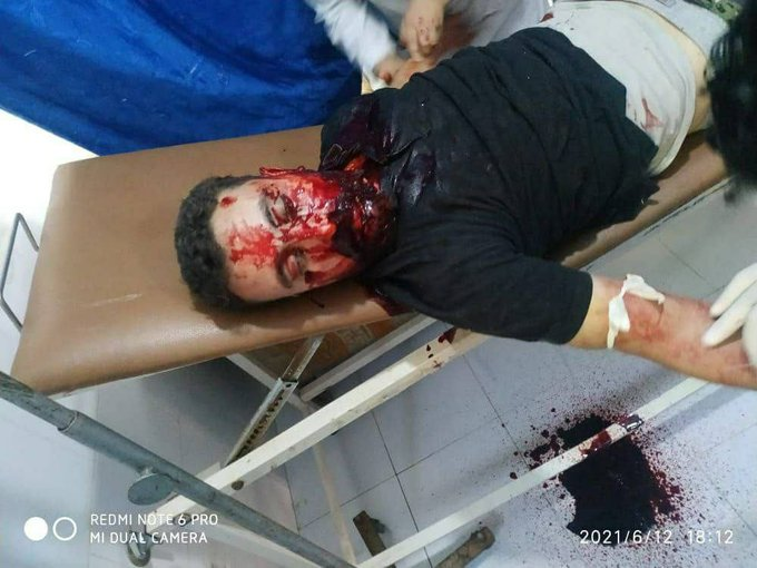 Image of an unidentified civilian who was injured in the bombing of Afrin on June 12, 2021. (Image posted by @Tb7FgaFJwxqQlKu)