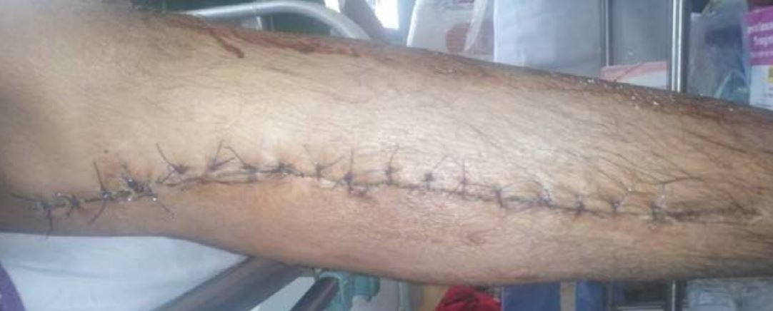 Mabkhout’s wounded leg after surgery in Marib General Hospital. Photo taken by the doctor. (via Mwatana)