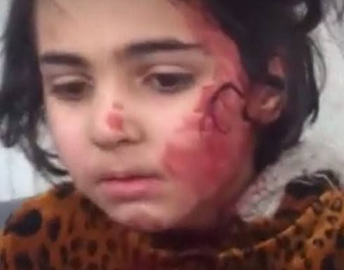 Iraqi Spring Media published an image of an injured child on February 21st, reporting that in the last 72 hours, 89 civilians - including 32 children - had died and 134 were injured in airstrikes and artillery shelling in west Mosul.