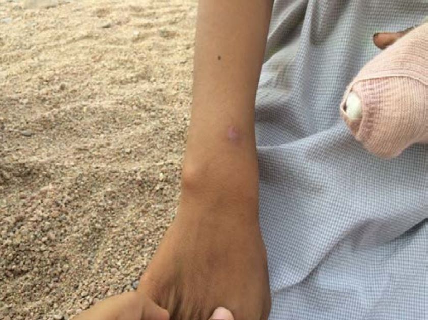 The front of Othman Mohammed Saleh Al Athal’s hand showing the scar from one of his injuries in the raid. Photo taken by a Mwatana researcher.