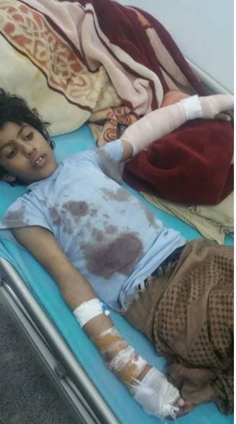 Othman Mohammed Saleh Al Athal, 12, injured during the May 23, 2017 raid in Marib governorate, Yemen (via Mwatana)
