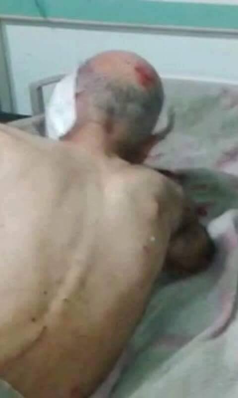 A photo of an injured man following an alleged Coalition strikes on Fallujah, June 15th (via AlFalujahNews)