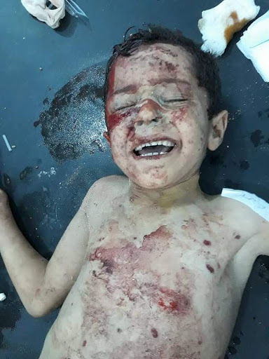 A child injured in alleged Russian airstrikes on Zardana in Idlib, Syria on June 7th, 2018 (via SCD)