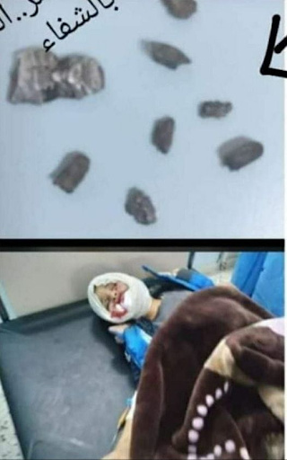 An image shared by Sabah News of the 10-year-old child killed as a result of a mortar attack on Al Minshiya in Libya on February 16th. The images shows the shrapnel taken for the child's body.