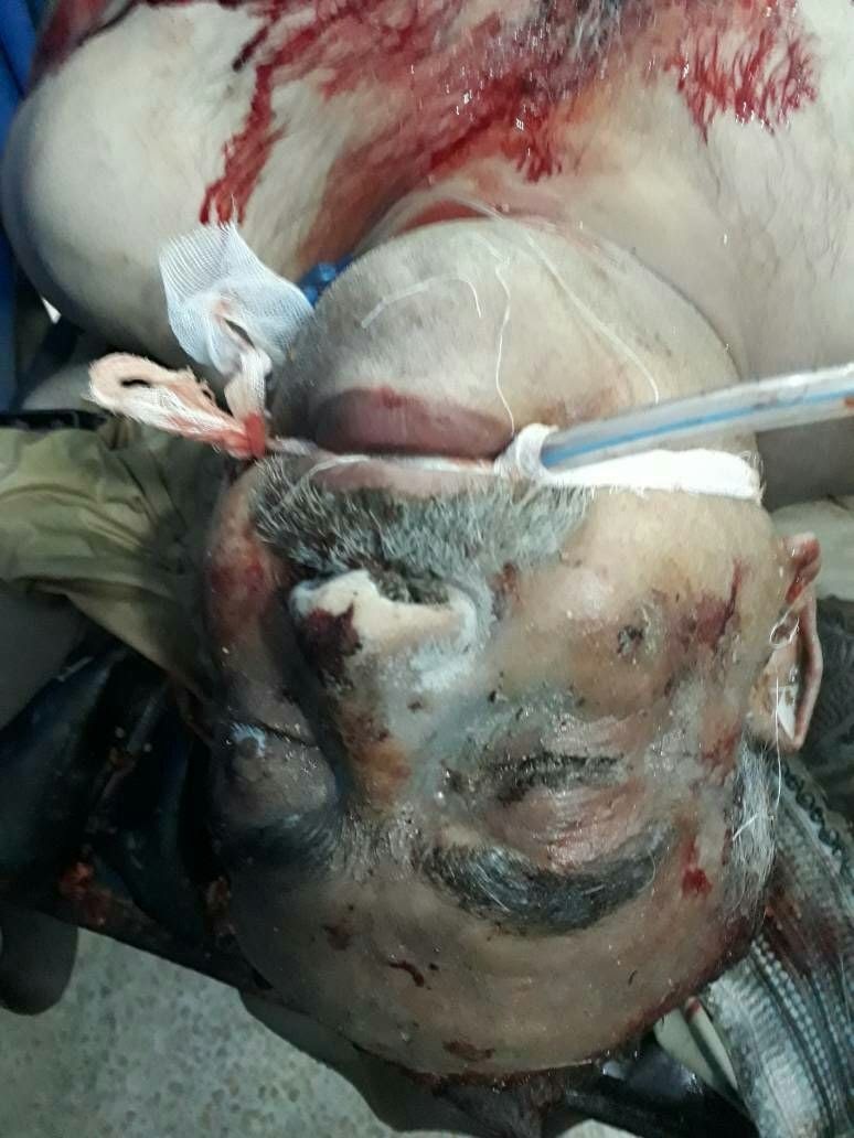 A civilian injured in alleged Russian airstrikes on Zardana in Idlib on June 7th, 2018 (via GMC)