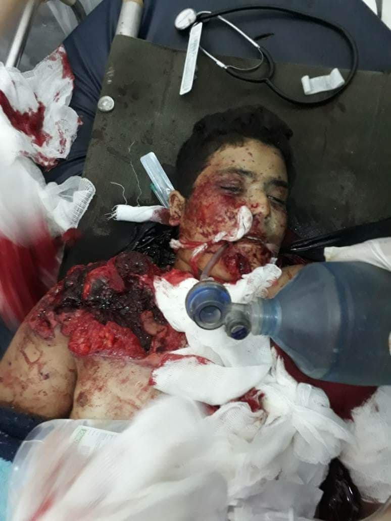A civilian seriously injured in alleged Russian airstrikes on Zardana in Idlib, Syria on June 7th, 2018 (via Moazz Shami).
