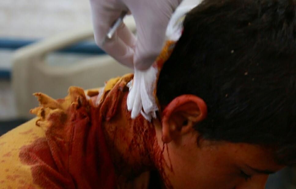 Injured boy receiving treatment after alleged coalition strike at Hit, Iraq April 20 2015 (