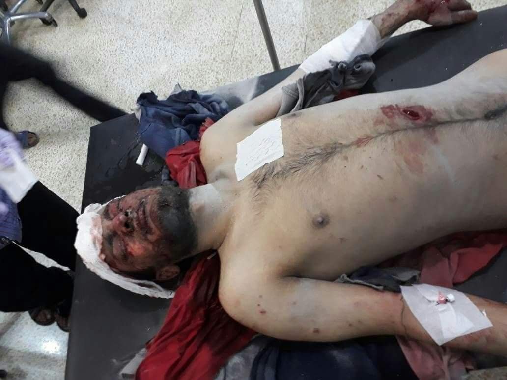 A civilian injured in alleged Russian airstrikes on Zardana in Idlib, Syria on June 7th, 2018 (via SCD)