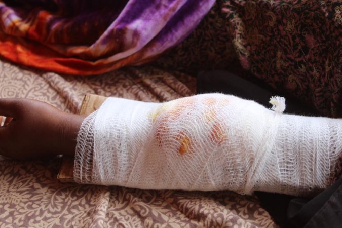 Injury allegedly sustained from US strike on Kunya Barrow on May 17th, 2020 (via Somali Memo)